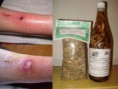 PSORIASIS, FUNGUS, AND WOUNDS (TWO PRODUCTS)